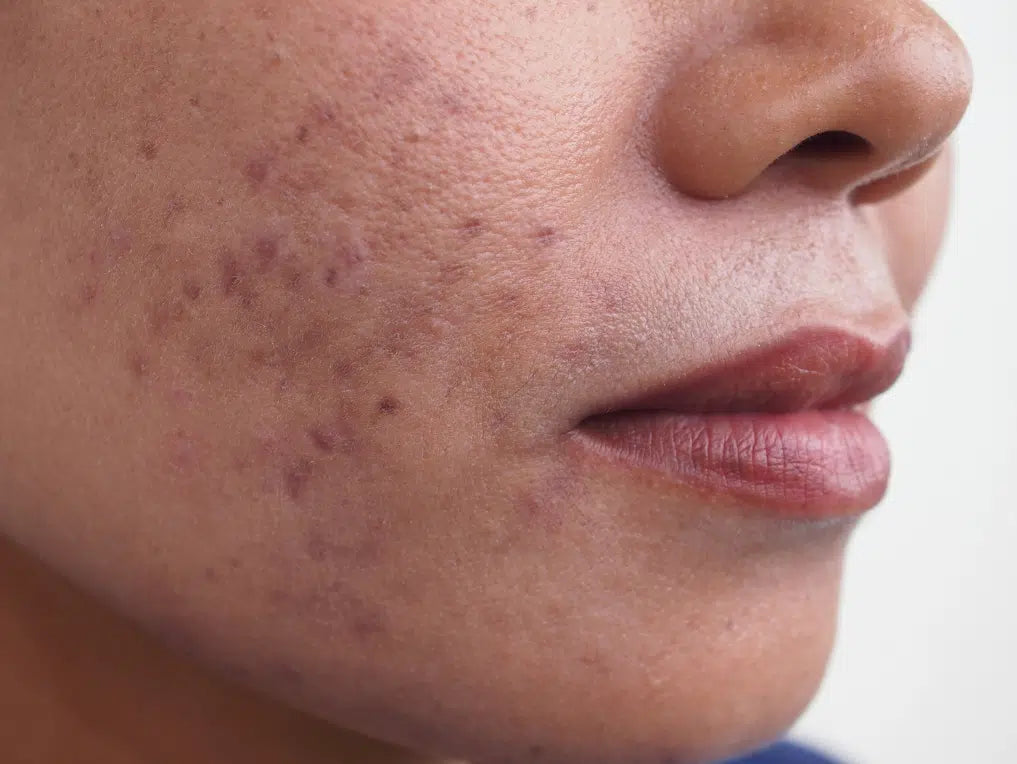 lady with hyperpigmentation