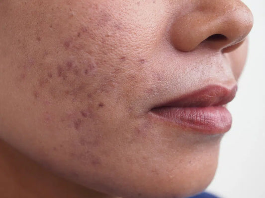 lady with hyperpigmentation
