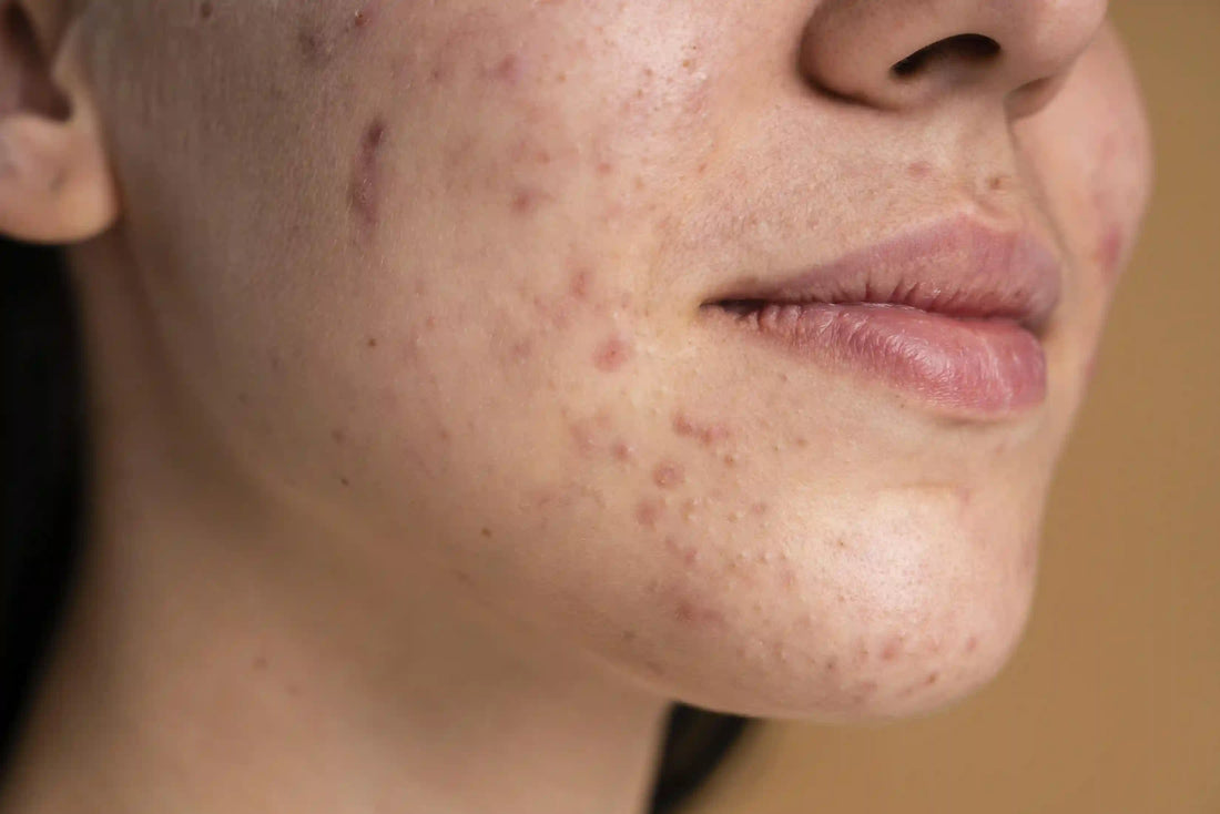 Acne Scars in Qatar: Types, Causes, and What Actually Works (2025 Guide)