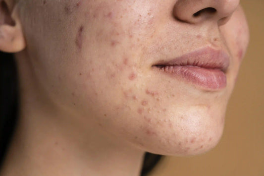 Acne Scars in Qatar: Types, Causes, and What Actually Works (2025 Guide)